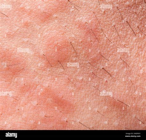 éruption Cutanée Urticaire Dermatite Rashs Cutanés Photo Stock Alamy