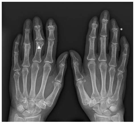 Jcm Free Full Text Hand Erosive Osteoarthritis And Distal