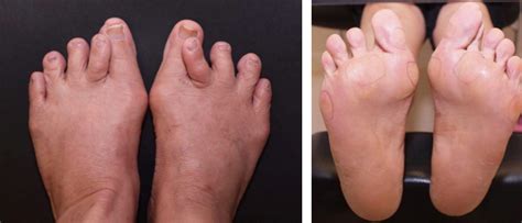 Curly Or Overlapping Toes Total Care Podiatry