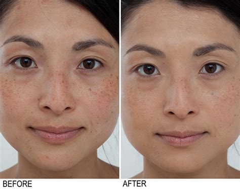 Retinoids can also be drying, so people should use a quality moisturizer and start slowly. Clinical Results: Bakel Brightening Serum Before and After ...