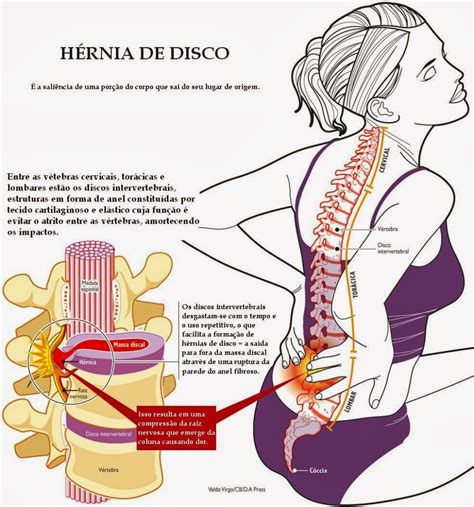 ¿en Qué Consiste Una Hernia Discal Tratamientos Hernias De Disco