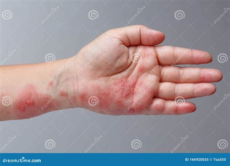 Herpes Skin Rash On Hand Shingles Herpes Zoster Rash On Hand Stock