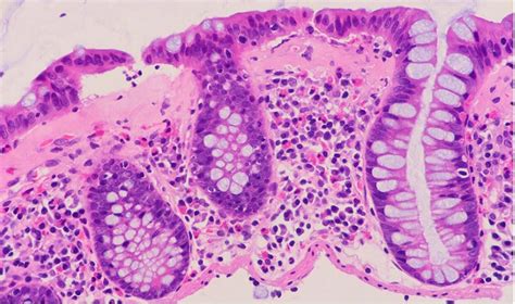 Mistakes In Microscopic Colitis And How To Avoid Them Ueg United European Gastroenterology