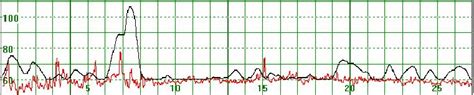 The Mhr Varies Around 60 Bpm The Vertical Scale Gives The Heart Rate In