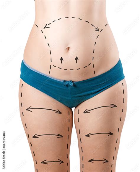 Plastic Surgery Of The Female Body Liposuction Of The Hips Legs