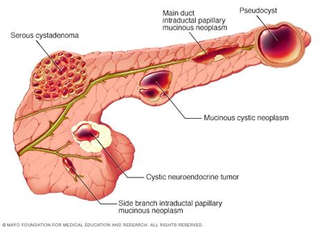 Pancreatic Cysts Diagnosis And Treatment Mayo Clinic