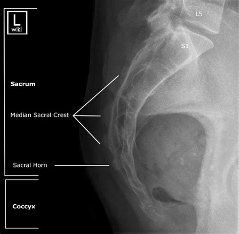 Sacrum Radiographic Anatomy Wikiradiography Radiology Diagnostic