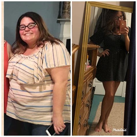 Before After Before And After Gastric Sleeve Photos BariatricPal