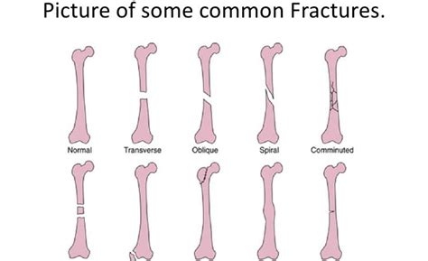 Broken Bones Types of Fractures and Bone Structure Anatomy