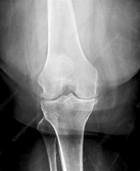 Osteoarthritis Of The Knee X Ray Stock Image C0299868 Science