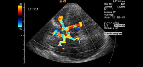 Ultrasounds Transcranial Doppler Imaging Checks For Risk Of Stroke