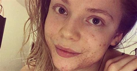 Young Woman Hounded By Cruel Instagram Trolls Over Horrific Acne Is