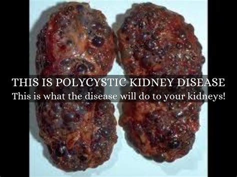 Polycystic Kidney Disease By Tristin Case
