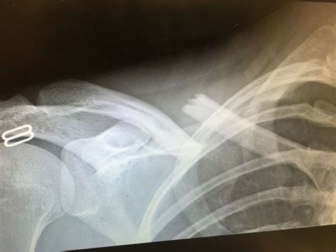 Broken Collarbone Clavicle On Right Side Of Body Clavicle