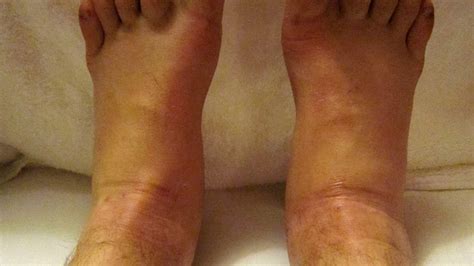 Swollen Ankle And Leg Causes Treatments And More