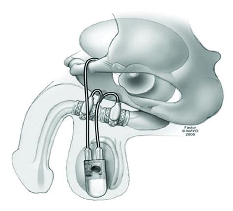 Graphical Representation Of The Tandem Cuff Artificial Urinary