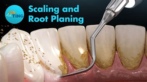 Scaling And Root Planing Srp Ask Dr Ting Youtube