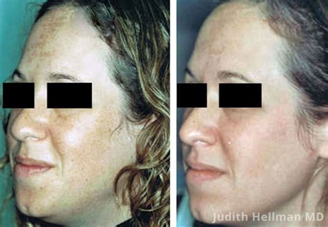 Melasma Treatment Before And After Photos New York
