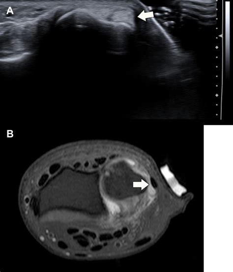 A And B Extensor Carpi Ulnaris Subluxation A Transverse Ultrasound