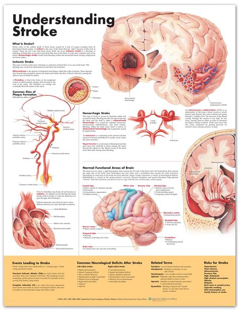Understanding Stroke Poster Stroke Anatomical Chart Company