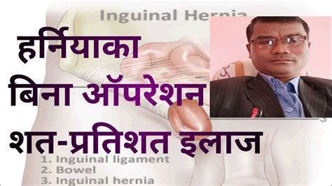 Hernia Treatment Without Surgeryhernia Treatment At Home Youtube