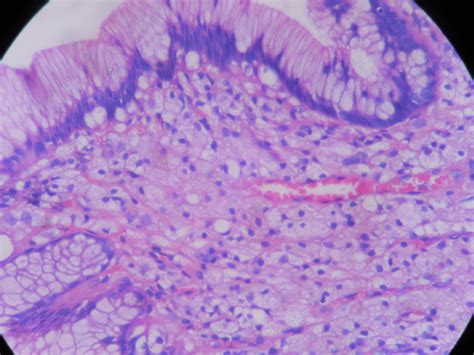 Gastric Xanthelasma Xanthoma Histopathologyguru