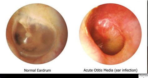 Normal Eardrum Vs Acute Otitis Media Infected Eardrum Ear Infection