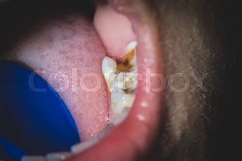 Tooth Decay Of Lower Molar Selective Stock Image Colourbox