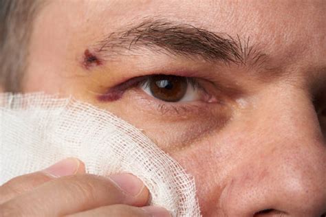 180 Eye Hematoma Stock Photos Pictures And Royalty Free Images Istock