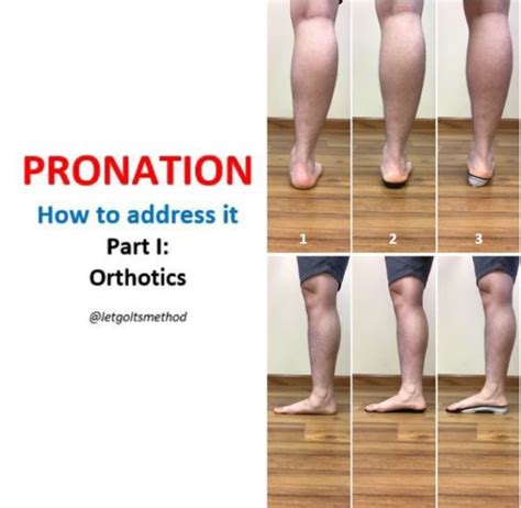 Pronation Part Vi How To Address Pronation I Orthotics