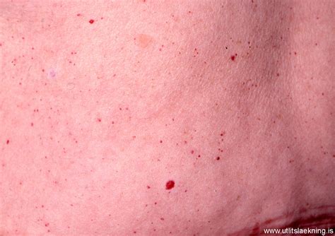 And also, i don't have anywhere near that many. cherry angiomas - pictures, photos