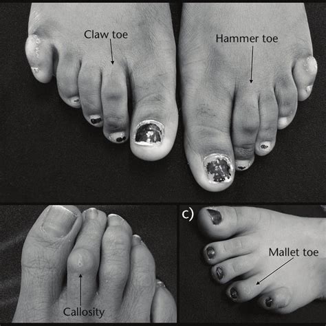 Pdf The Pathology And Management Of Lesser Toe Deformities
