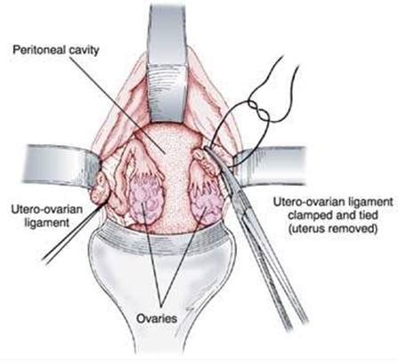 Hysterectomy Berek And Novak S Gynecology 15th Ed