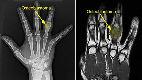 Osteoblastoma Orthoinfo Aaos