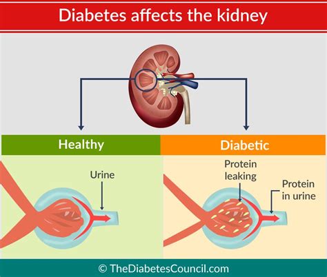 Serious Complications of Diabetes Mellitus - Fever.pk
