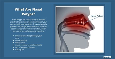 Nasal Polyps Causes Symptoms Treatments And Prevention