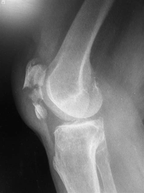 Patella Fracture Lateral X Ray Patella Fracture Medical Knowledge