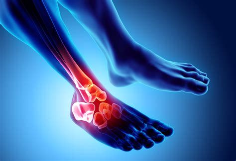 What Is A Lisfranc Injury Joi Jacksonville Orthopaedic Institute