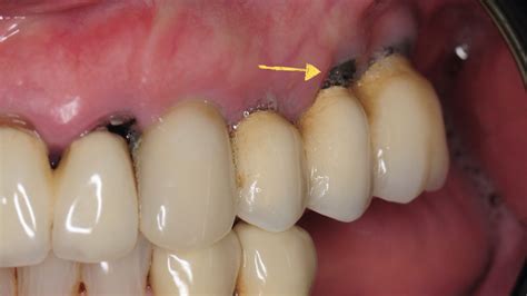 How To Prevent And Manage Black Lines Around Crowns And Gum Recession