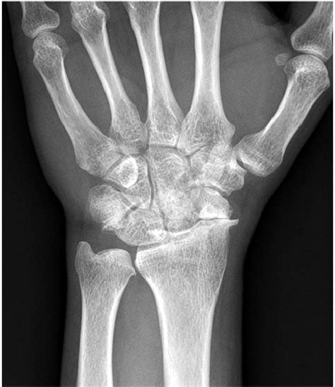 Scaphoid Nonunion Advanced Collapse Left Wrist Simple Radiograph Of A