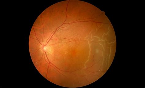 Diagnosis And Treatment Of Retinal Detachment In Gironde