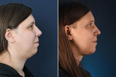 Facial Feminization Surgery Jaw Reduction Feminizing The Jaw