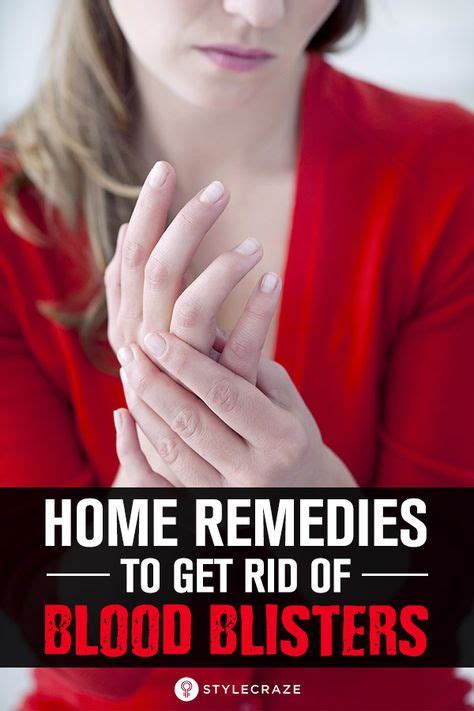 10 Effective Home Remedies To Get Rid Of Blood Blisters Blood Blister