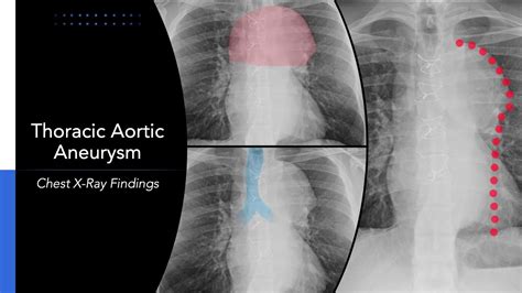Thoracic Aortic Aneurysm Explanation Of Chest X Ray Findings Youtube