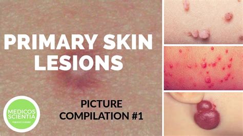 Primary Skin Lesions Picture Compilation Medicos Scientia Youtube