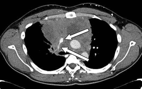 Primary Mediastinal Large B Cell Lymphoma A Review For Radiologists Ajr