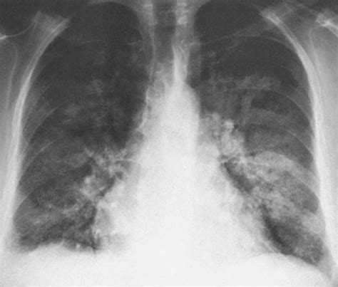 Pulmonary edema is a broad descriptive term and is usually defined as an abnormal accumulation of fluid in the extravascular compartments of the lung 1. Pulmonary Edema and Symmetrical Bilateral Infiltrates ...