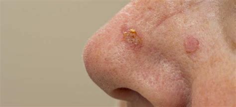 Squamous Cell Carcinoma Know Its Causes And Treatment