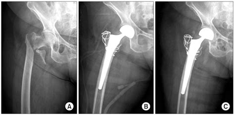 Bipolar Hemiarthroplasty With Cementless Femoral Stem For Unstable