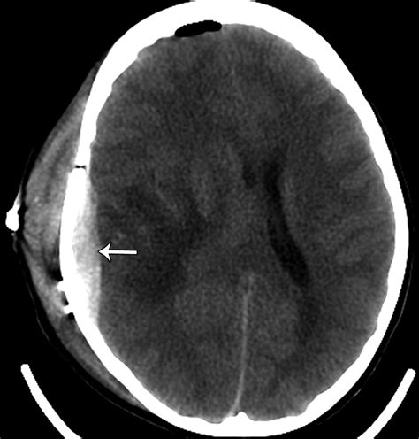 Imaging Of The Post Operative Cranium Radiographics